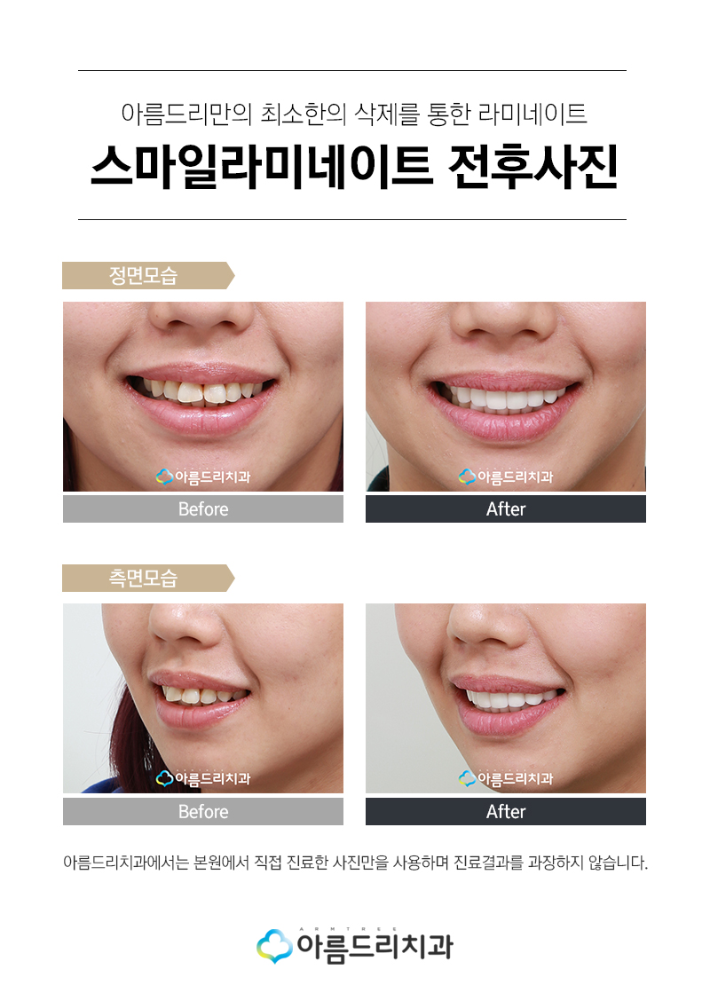 라미네이트연예인 이빨(치아) 최소삭제 이거다 관련 이미지 11