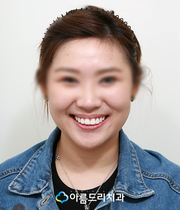 벌어진앞니 앞니라미네이트 치료후기 관련 이미지 9
