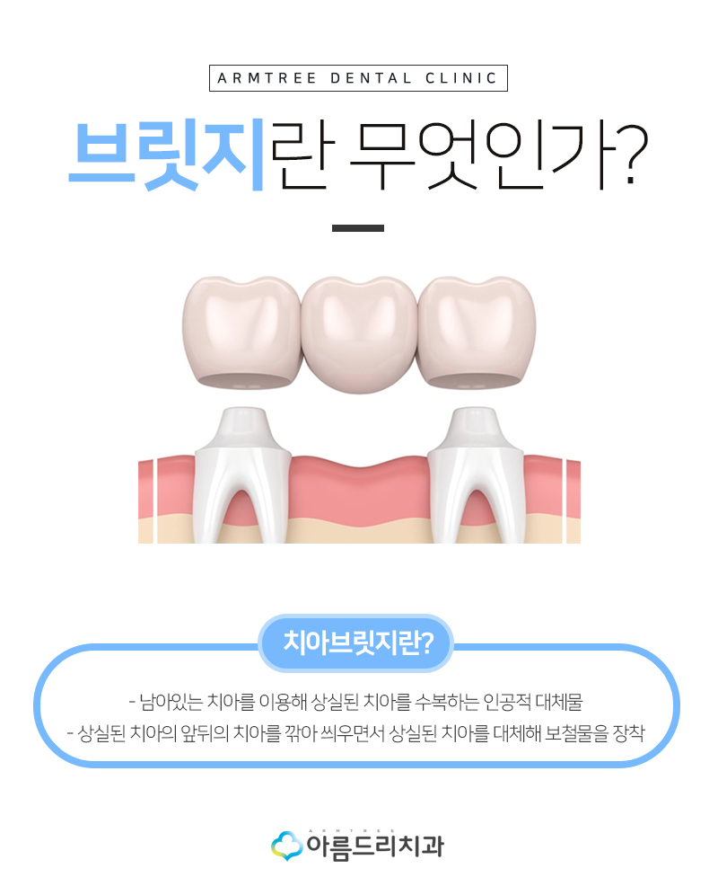 앞니 브릿지가 깨졌어요 치과치료 관련 이미지 5