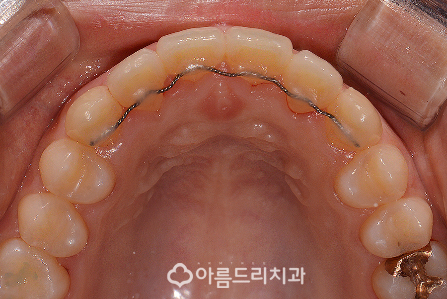 앞니부분교정기간 후기의 변화 관련 이미지 9