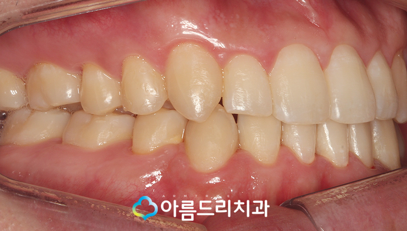 투명교정장치 인비절라인 치과 후기 관련 이미지 11