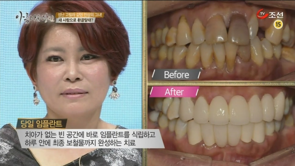 이현정원장의 아름다운 당신 시즌 2 (8회 윤해숙 도전자) 치주치료, 충치치료, 원데이 임플란트, 네비게이션 임플란트, 돌출입 심미보철, 치아미백, 스마일 트레이닝 관련 이미지 7