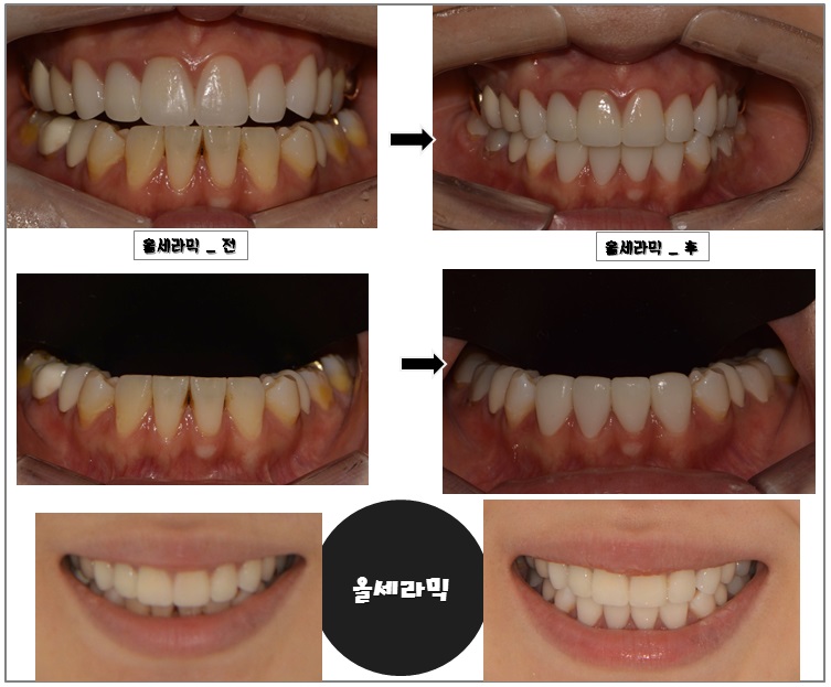 앞니 변색 _ 블랙 트라이앵글 #올 세라믹 관련 이미지 5