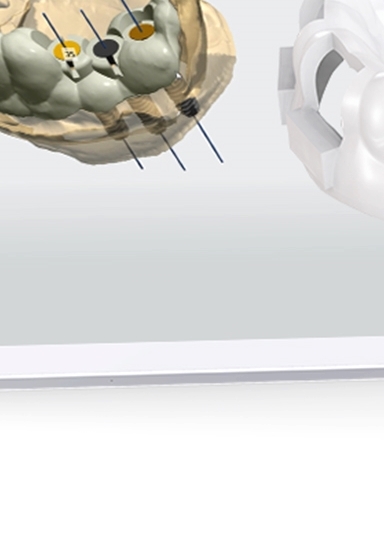 디지털임플란트 당일임플란트로 정확하고 안전하다면 관련 이미지 23