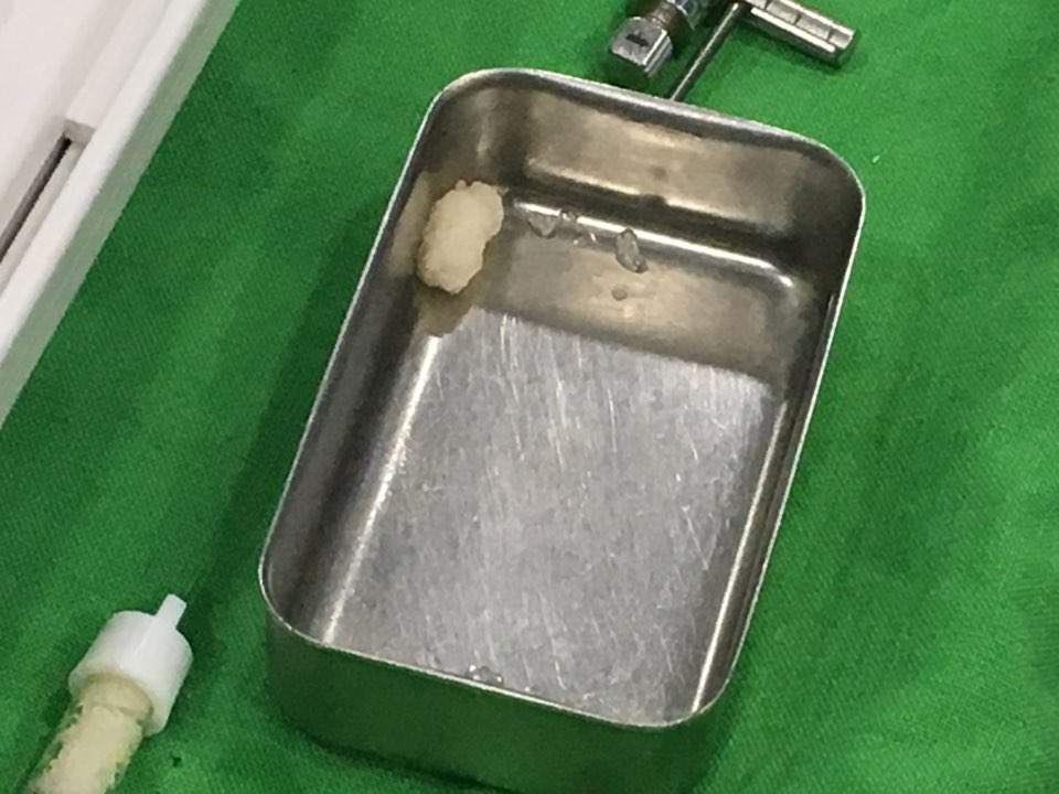 앞니 임플란트_뼈이식_신논현역 치과_아름드리 치과 관련 이미지 18