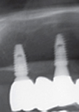 반포치과 전악임플란트는 풀아치 임플란트로 관련 이미지 6