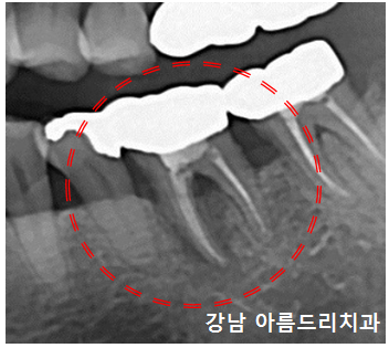 치아 통증은 있는데 이상은 없다?(재식, 임플란트_아름드리 치과) 관련 이미지 3
