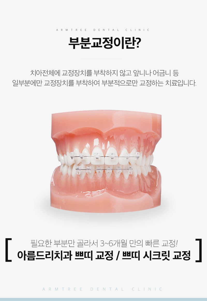 아랫니부분교정 아랫니만 가능한 아름드리치과 관련 이미지 4