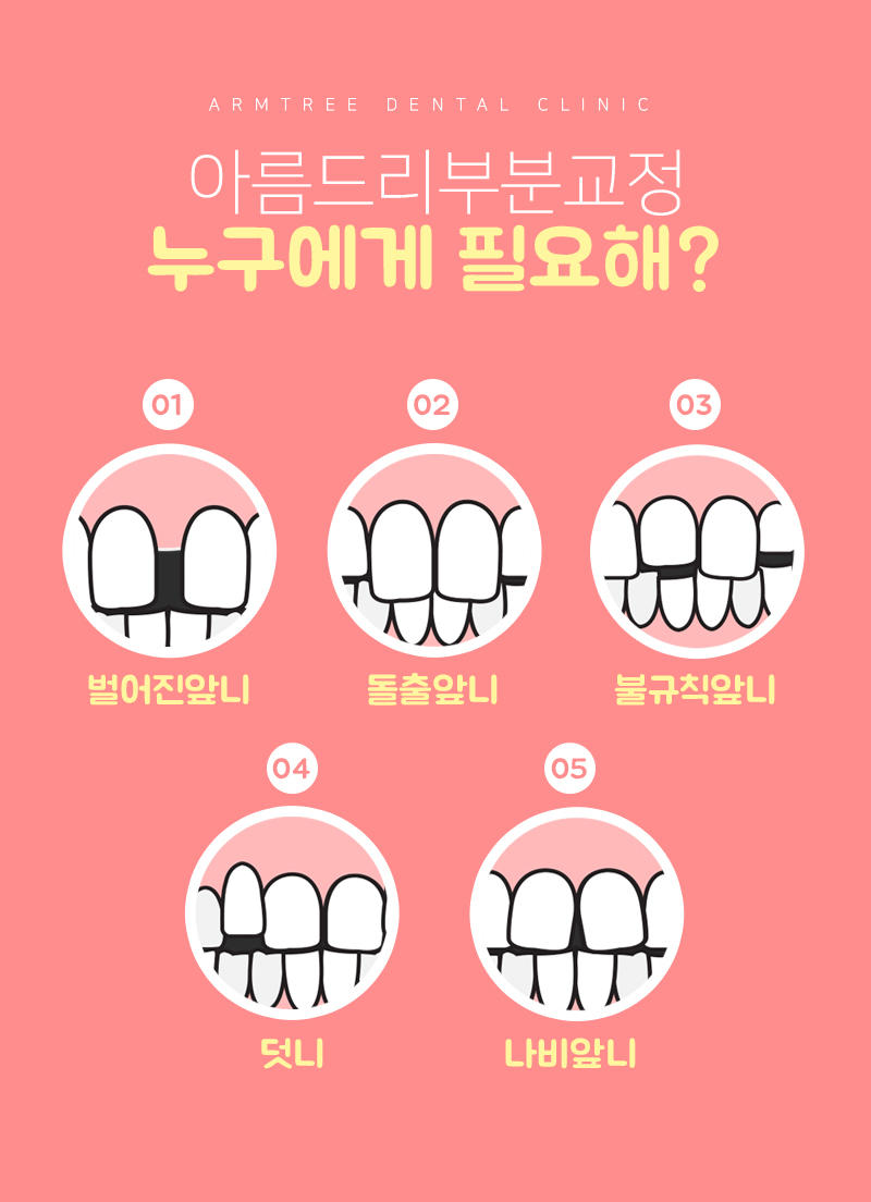 치아벌어짐 치아사이틈 3개월후기! 관련 이미지 4