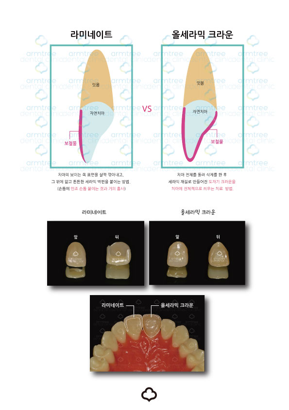 건강한 앞니성형_강남 아름드리 치과가 알려드리는 TIP 관련 이미지 4