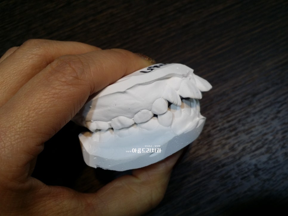 신논현치과 치아교정_앞니교정 계획 중이신가요? 관련 이미지 3