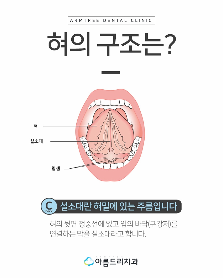 성인설소대수술후기 설소대단축증 아름드리치과 관련 이미지 2