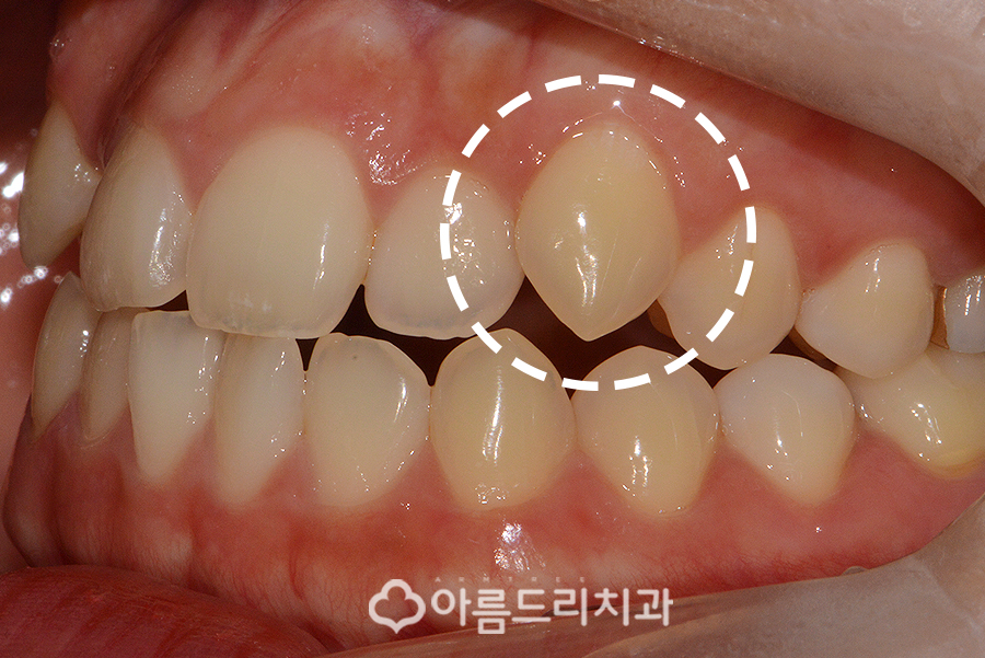 앞니부분교정기간 후기의 변화 관련 이미지 4