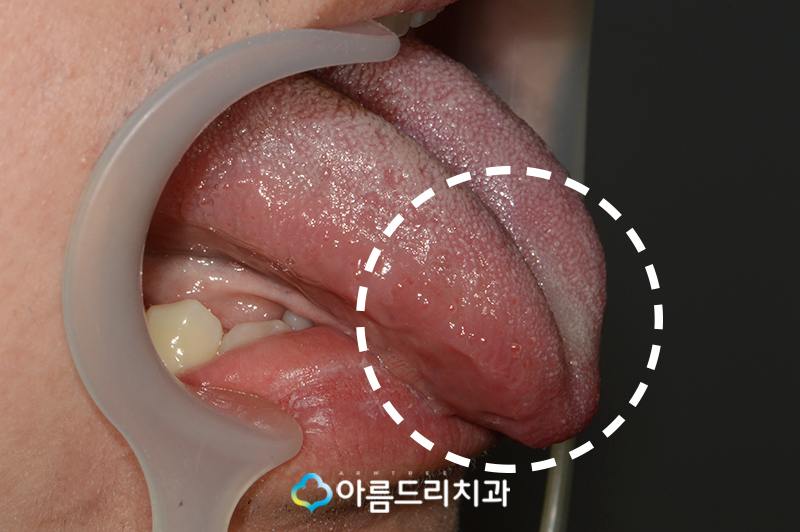 성인설소대수술 후기 단축증 해결 관련 이미지 3