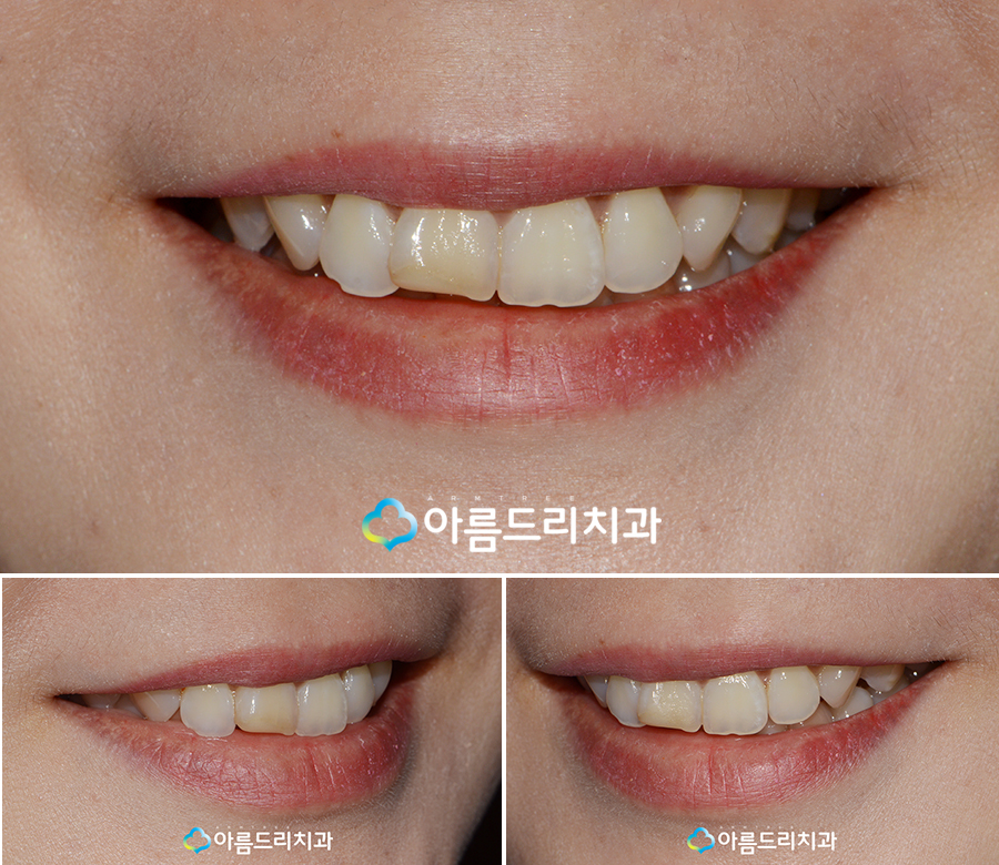 치아라미네이트 삭제량이 초중요 관련 이미지 3