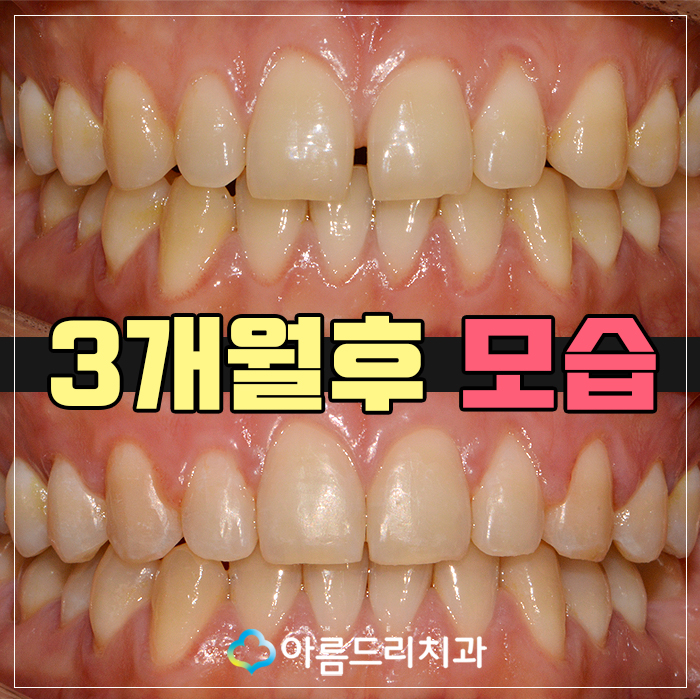 치아벌어짐 치아사이틈 3개월후기! 관련 이미지 1