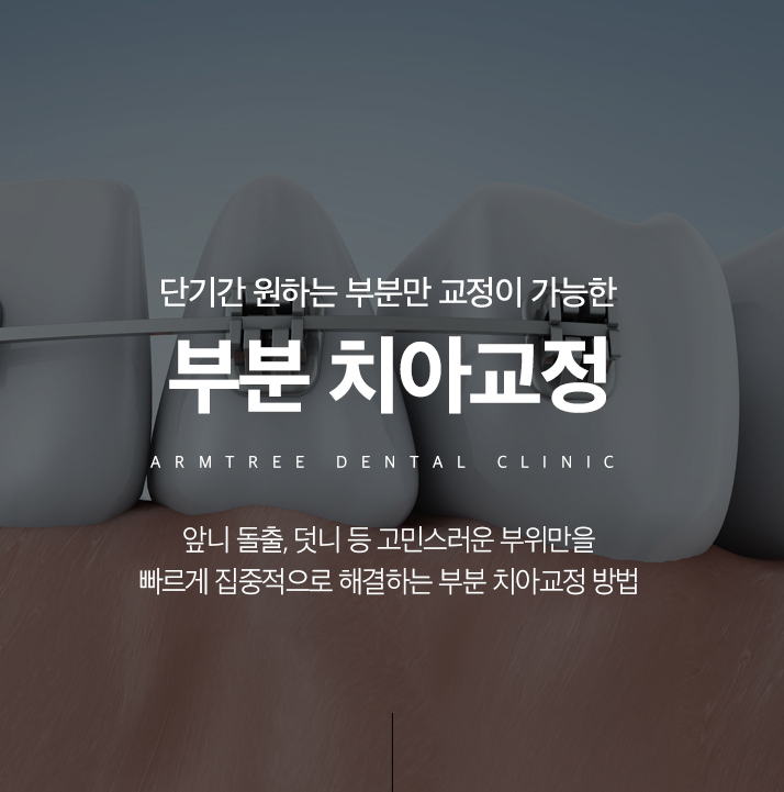 앞니부분교정 꼼꼼하고 예리하게 관련 이미지 1