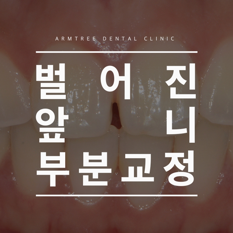 벌어진앞니부분교정 후기 신논현역 아름드리치과는 관련 이미지 1