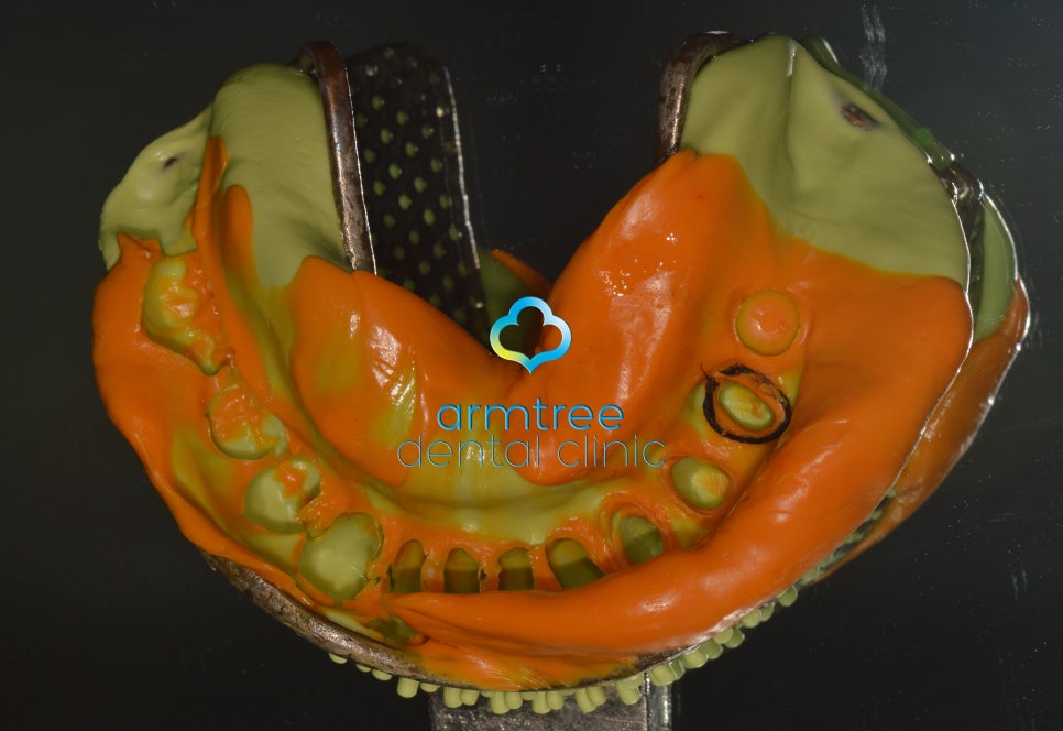 아름드리치과 이현정원장의 치료 이야기- 라미네이트란? 관련 이미지 7