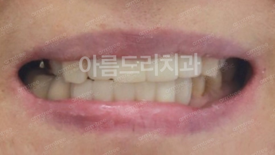 임플란트가 무조건 최선은 아니다! 아름드리치과 진료일기 관련 이미지 12