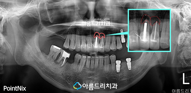 치근단절제술 수술후기 자연치아 살리기 관련 이미지 3