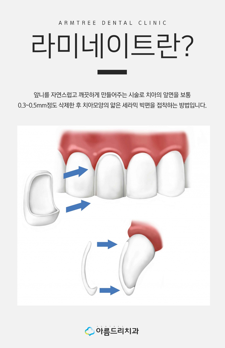 앞니깨짐 치료후기 해결책 관련 이미지 5