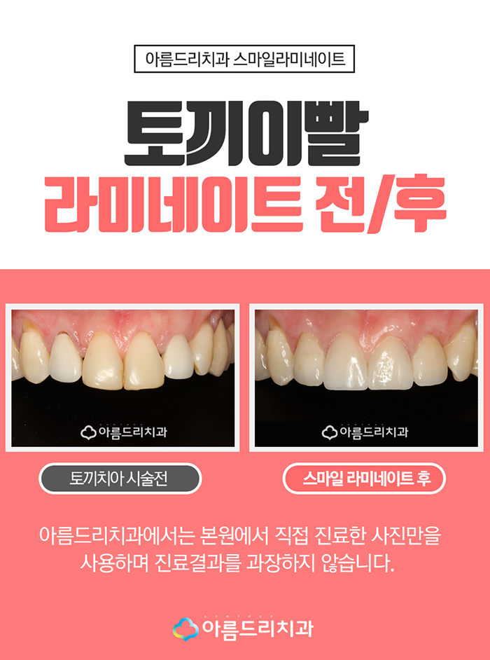 토끼이빨라미네이트 눈깜짝할 사이에 관련 이미지 6