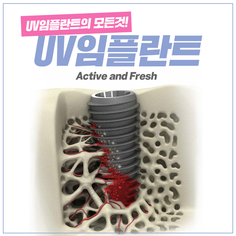 UV임플란트 더욱 완벽하게 관련 이미지 1