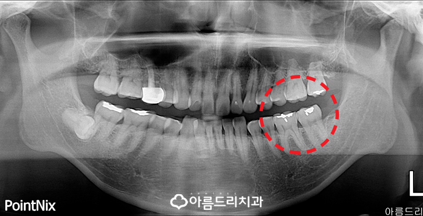 충치인레이 아말감주변 충치치료는? 관련 이미지 2