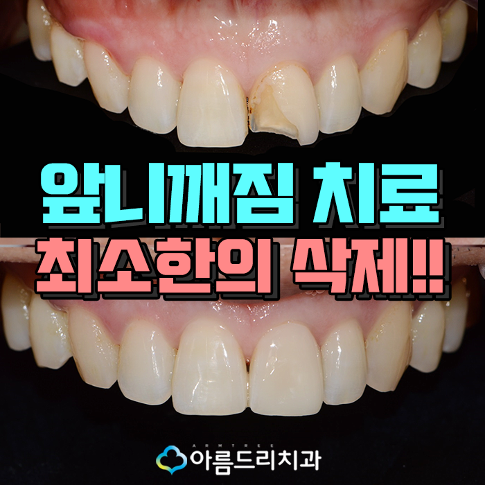 앞니깨짐 치료후기 해결책 관련 이미지 1