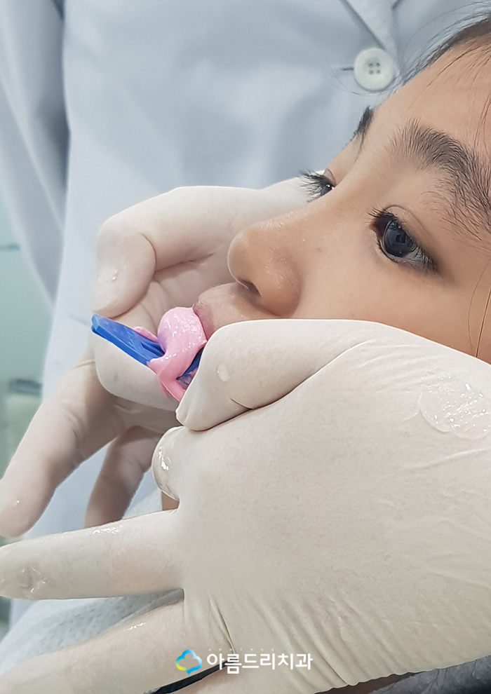 어린이치아교정 부정교합 RPE(급속구개확장장치) 악궁확장장치 관련 이미지 10