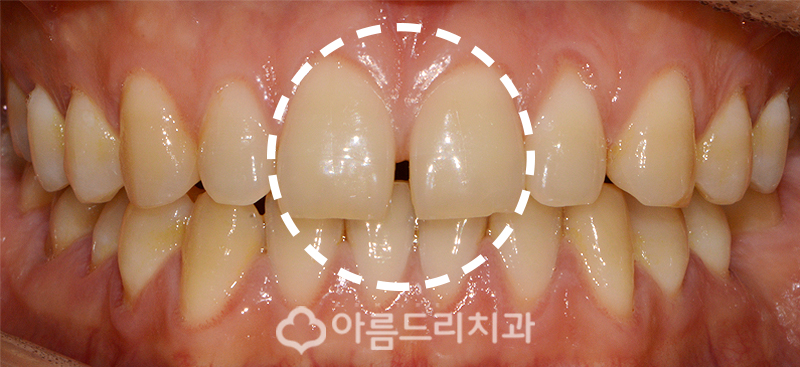 치아벌어짐 치아사이틈 3개월후기! 관련 이미지 3