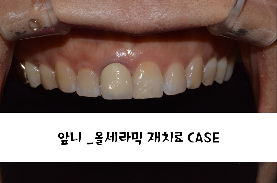 앞니 올세라믹 _재시술 (잇몸변색,메탈노출) 관련 이미지 1
