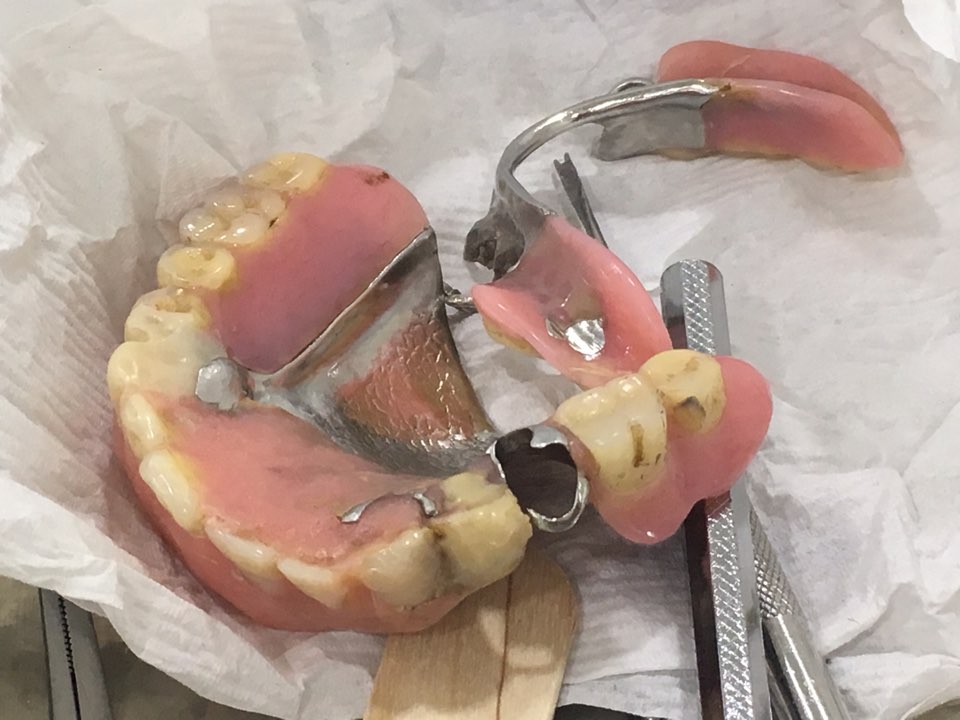 앞니 임플란트_뼈이식_신논현역 치과_아름드리 치과 관련 이미지 17