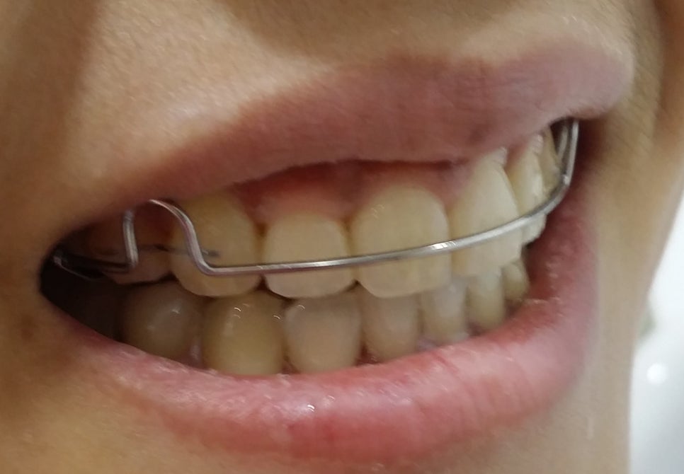 치아교정 후 유지 장치 세척&관리법 Tip_강남 아름드리 치과 관련 이미지 1