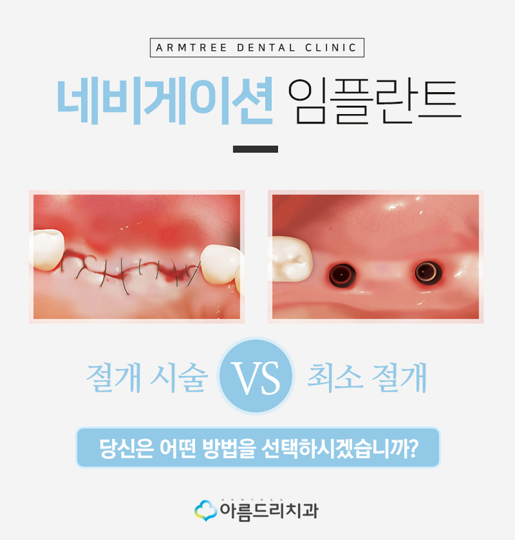 네비게이션임플란트 부작용과 통증놉 관련 이미지 4