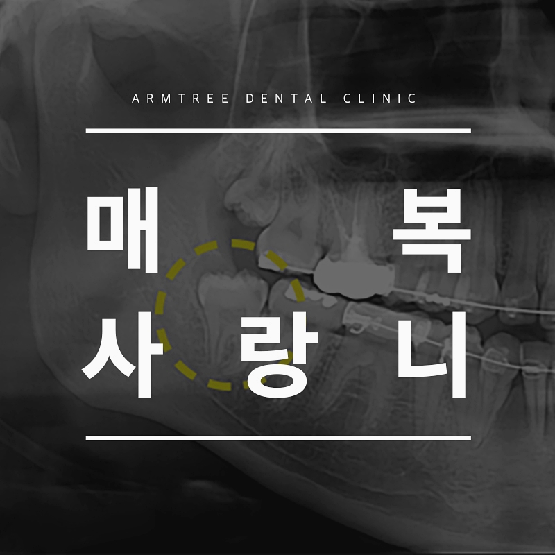 매복사랑니 발치후기통증 아름드리치과 관련 이미지 1