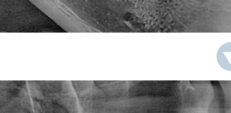 신논현역임플란트 아름드리치과에서 상악동거상술이 필요하면 관련 이미지 10