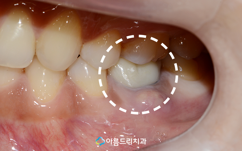 치아재식술 치료후기 자연치아살리기 관련 이미지 3