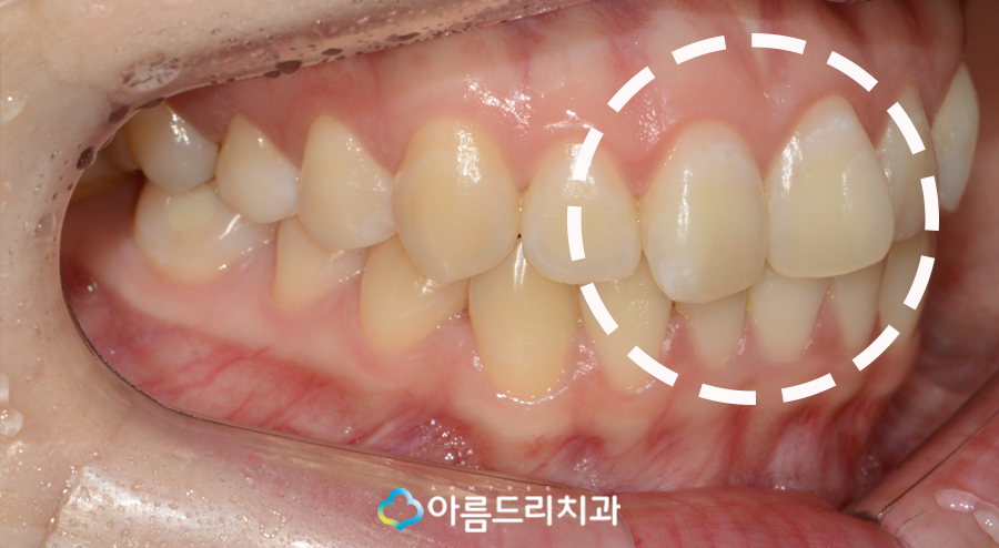나비치아 교정 앞니 부분교정 후기 관련 이미지 4