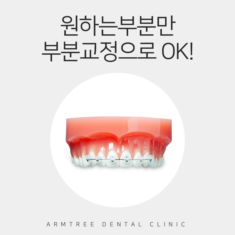 아랫니부분교정 가격 후기 정보후기 관련 이미지 5