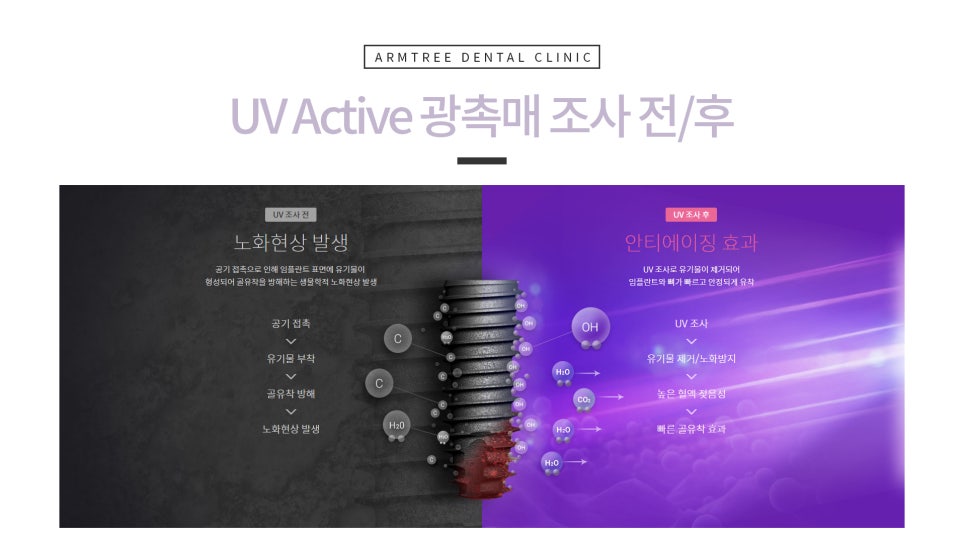 UV임플란트 역시 아름드리 관련 이미지 4