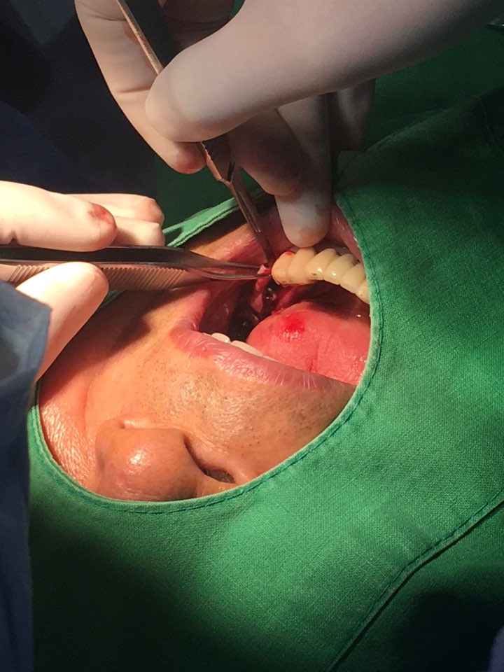 신논현역치과 PRF 자가혈 임플란트. 안전한 임플란트_아름드리 치과 관련 이미지 15