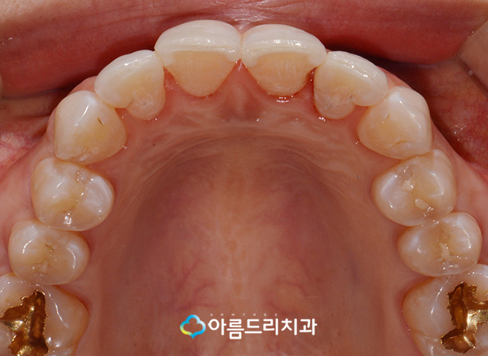 토끼이빨교정 앞니문제 해결 관련 이미지 8