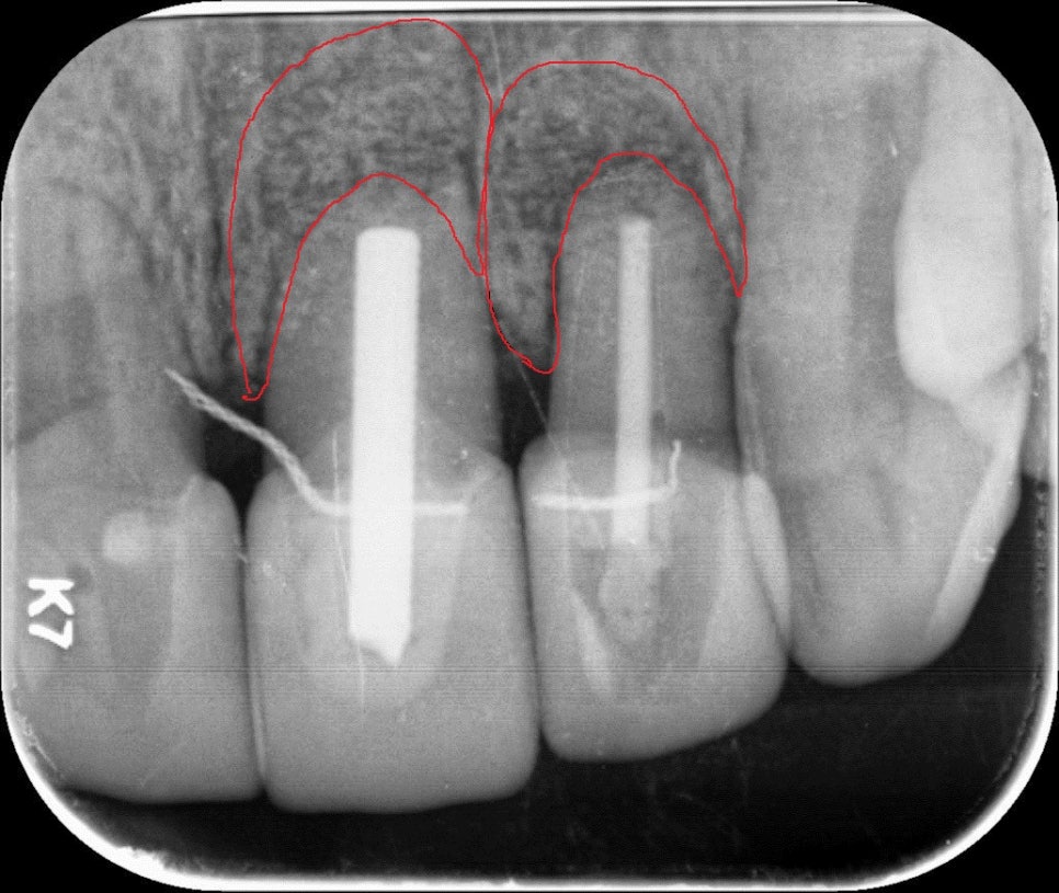 뽑지 않고 자가치아를 살려주세요_치아 뿌리수술_치근단절제술+뼈이식 관련 이미지 7