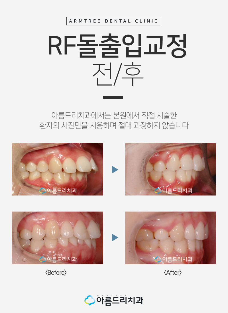 입툭튀교정 돌출앞니 환자후기 관련 이미지 6