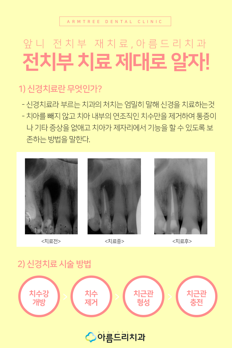 앞니 임시치아 전치부 크라운 재치료 관련 이미지 3