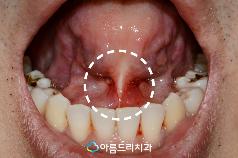 성인 설소대 수술 시술 완벽하게 관련 이미지 5