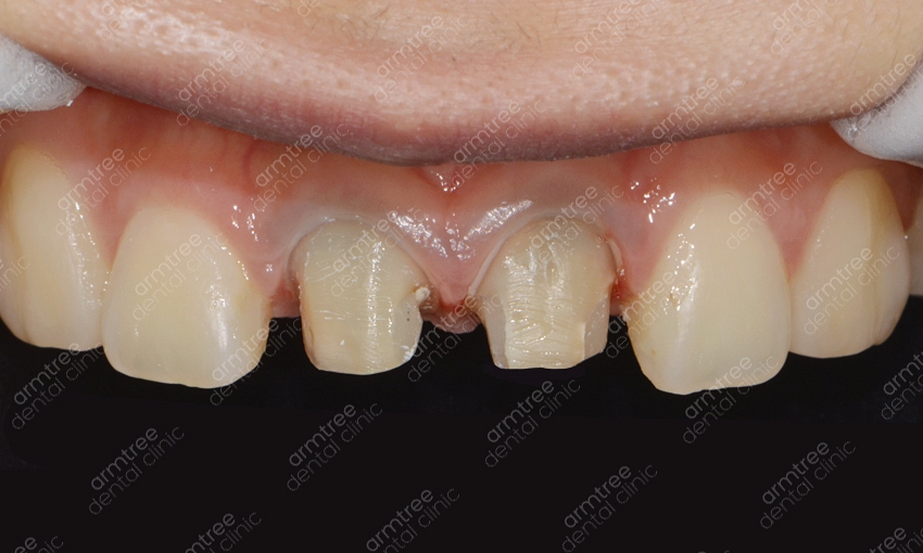 실활치미백 앞니변색 걱정없는 아름드리치과 관련 이미지 4