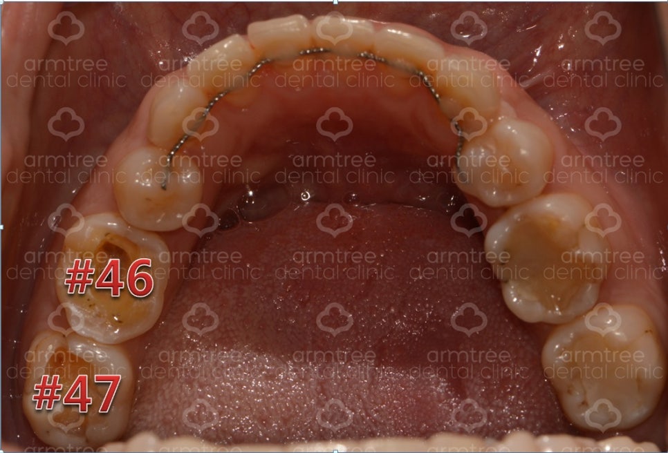 [치아 신경치료] #46,47번(오른쪽 아래 치아) 통증으로 내원 관련 이미지 6